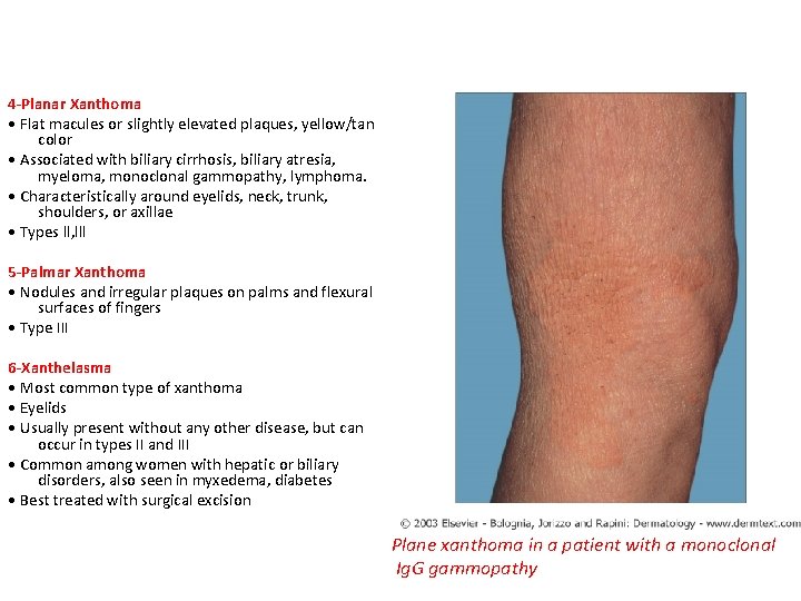 4 -Planar Xanthoma • Flat macules or slightly elevated plaques, yellow/tan color • Associated