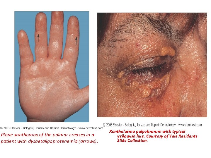 Plane xanthomas of the palmar creases in a patient with dysbetalipoprotenemia (arrows). Xanthelasma palpebrarum