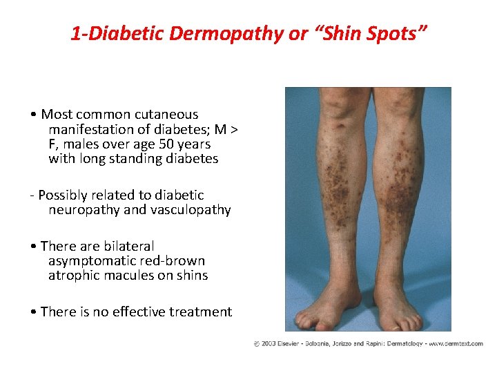 1 -Diabetic Dermopathy or “Shin Spots” • Most common cutaneous manifestation of diabetes; M