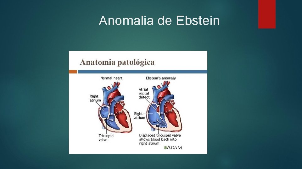  Anomalia de Ebstein 