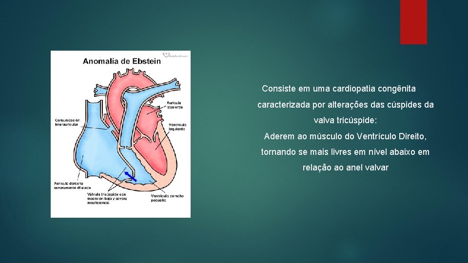 Consiste em uma cardiopatia congênita caracterizada por alterações das cúspides da valva tricúspide: Aderem