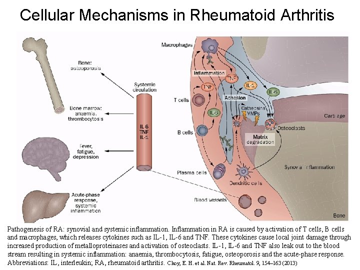 Cellular Mechanisms in Rheumatoid Arthritis Pathogenesis of RA: synovial and systemic inflammation. Inflammation in