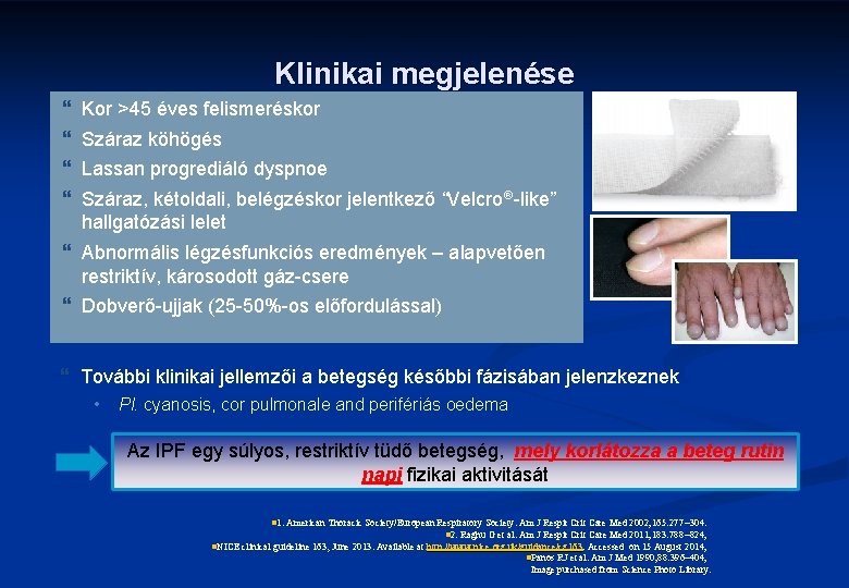 Klinikai megjelenése } } Kor >45 éves felismeréskor Száraz köhögés Lassan progrediáló dyspnoe Száraz,