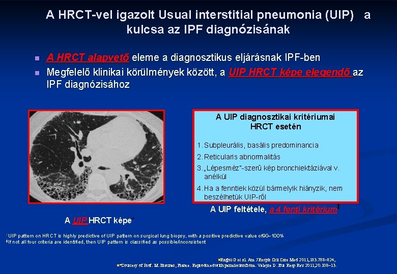 A HRCT-vel igazolt Usual interstitial pneumonia (UIP) a kulcsa az IPF diagnózisának n n