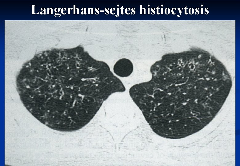 Langerhans-sejtes histiocytosis 44 