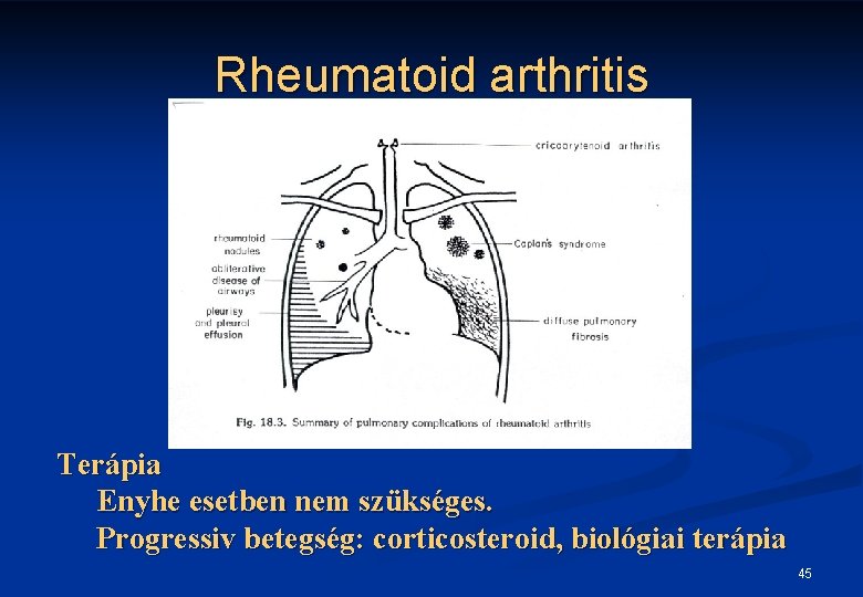 Rheumatoid arthritis Terápia Enyhe esetben nem szükséges. Progressiv betegség: corticosteroid, biológiai terápia 45 