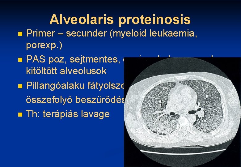 Alveolaris proteinosis n n Primer – secunder (myeloid leukaemia, porexp. ) PAS poz, sejtmentes,