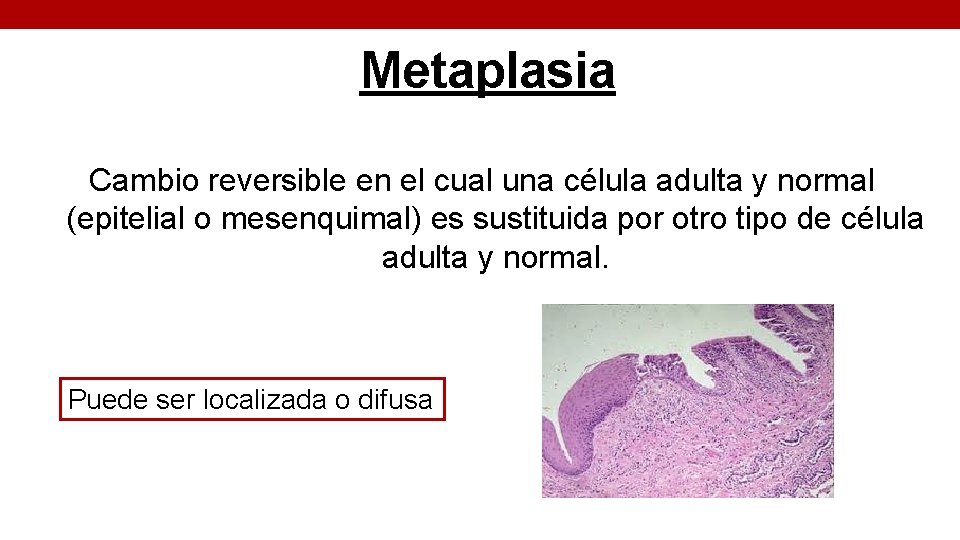 Metaplasia Cambio reversible en el cual una célula adulta y normal (epitelial o mesenquimal)