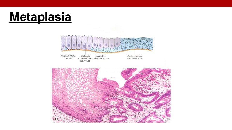 Metaplasia 