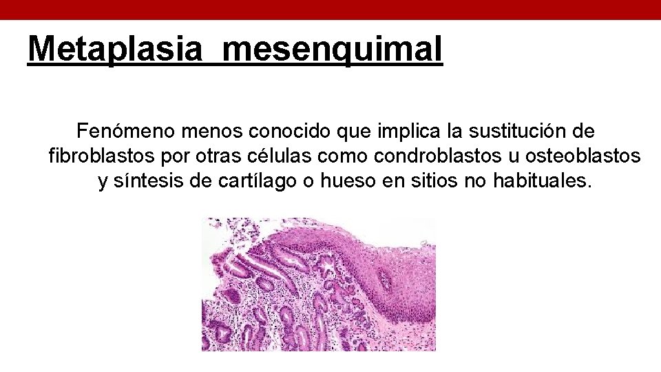 Metaplasia mesenquimal Fenómenos conocido que implica la sustitución de fibroblastos por otras células como