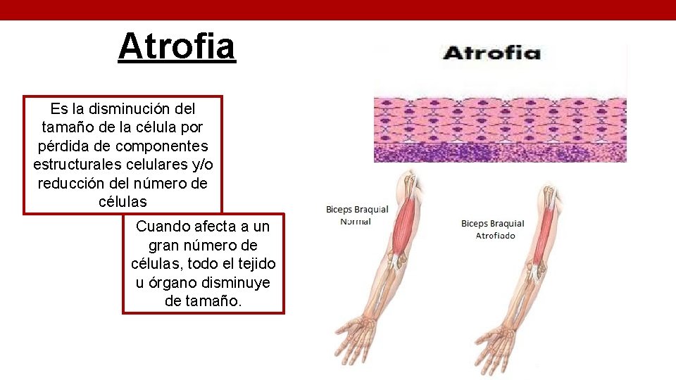 Atrofia Es la disminución del tamaño de la célula por pérdida de componentes estructurales