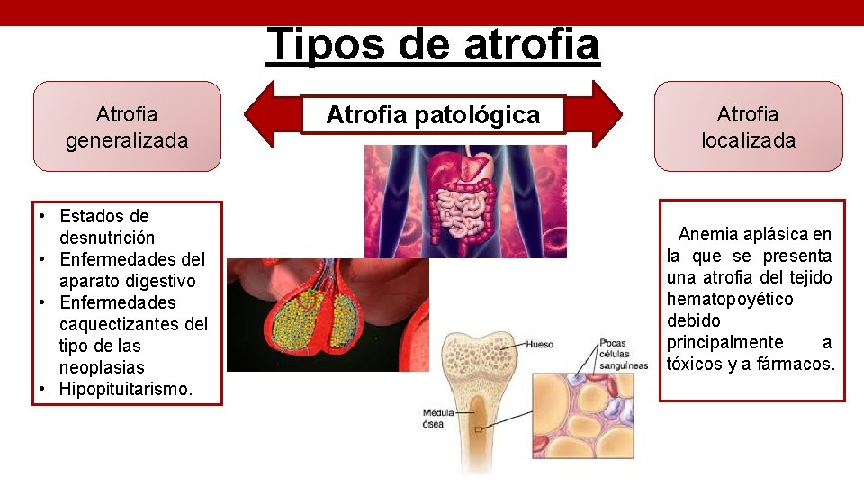 Tipos de atrofia Atrofia generalizada • Estados de desnutrición • Enfermedades del aparato digestivo