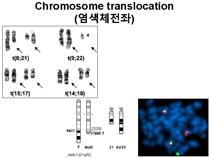 Chromosome translocation (염색체전좌) 