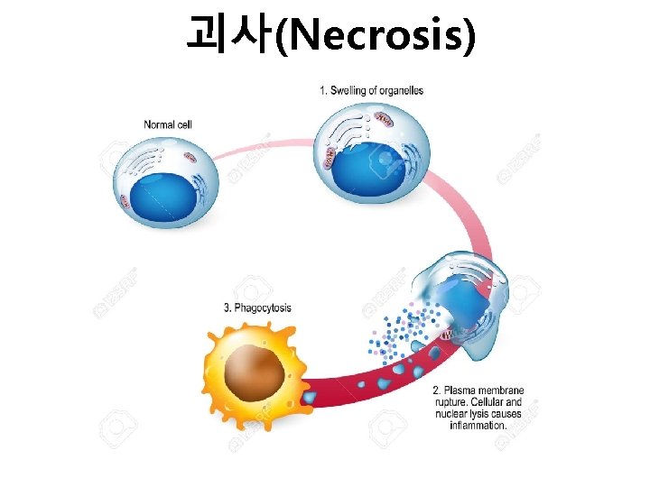 괴사(Necrosis) 