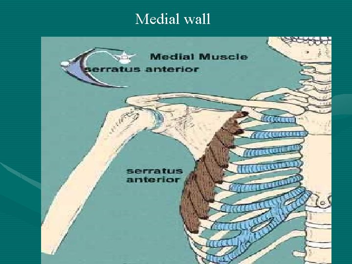 Medial wall 