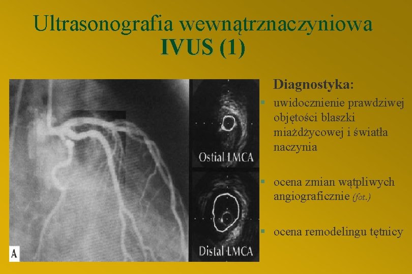 Ultrasonografia wewnątrznaczyniowa IVUS (1) Diagnostyka: § uwidocznienie prawdziwej objętości blaszki miażdżycowej i światła naczynia