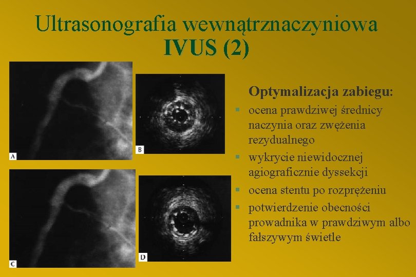 Ultrasonografia wewnątrznaczyniowa IVUS (2) Optymalizacja zabiegu: § ocena prawdziwej średnicy naczynia oraz zwężenia rezydualnego