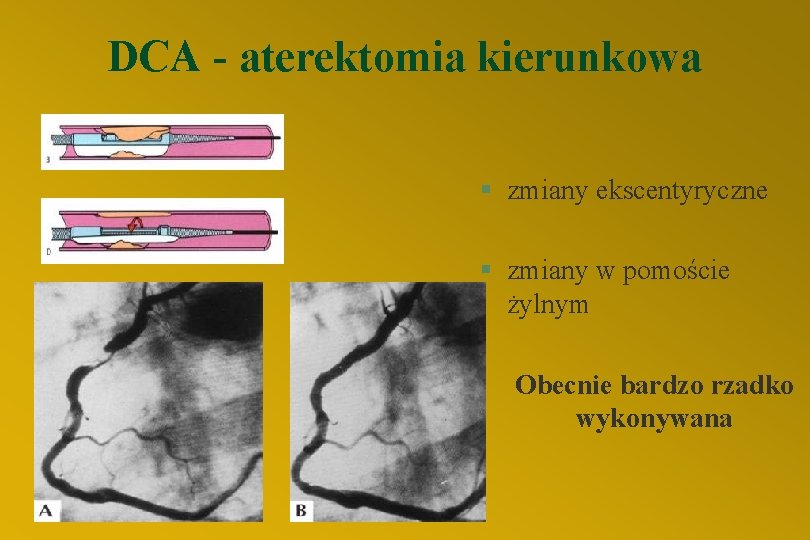 DCA - aterektomia kierunkowa § zmiany ekscentyryczne § zmiany w pomoście żylnym Obecnie bardzo