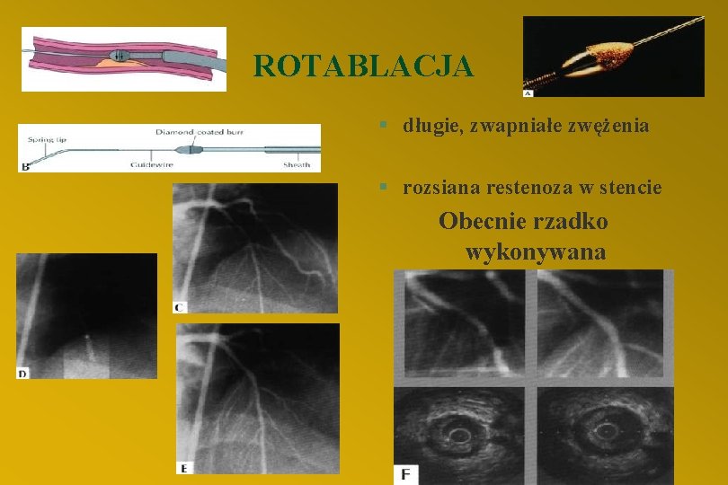 ROTABLACJA ROTA § długie, zwapniałe zwężenia § rozsiana restenoza w stencie Obecnie rzadko wykonywana