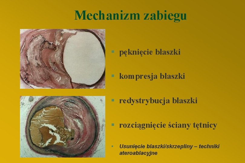 Mechanizm zabiegu § pęknięcie blaszki § kompresja blaszki § redystrybucja blaszki § rozciągnięcie ściany