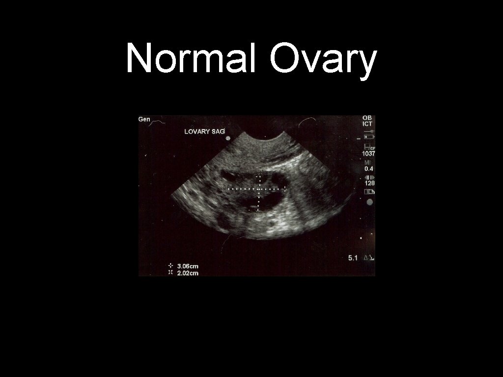 Normal Ovary 
