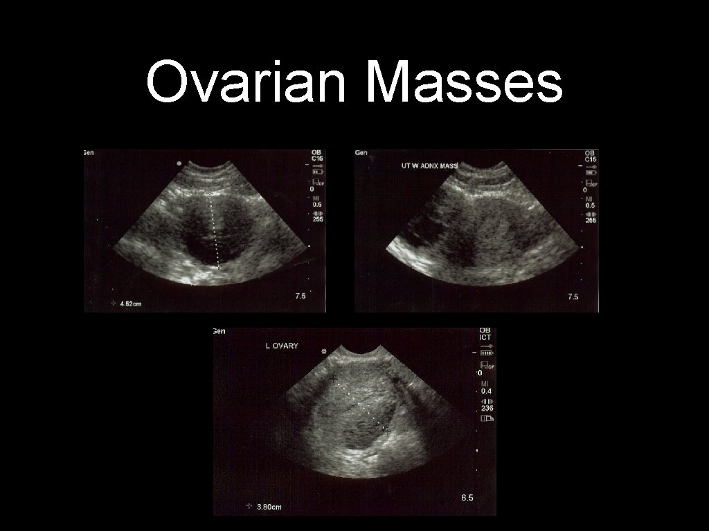 Ovarian Masses 
