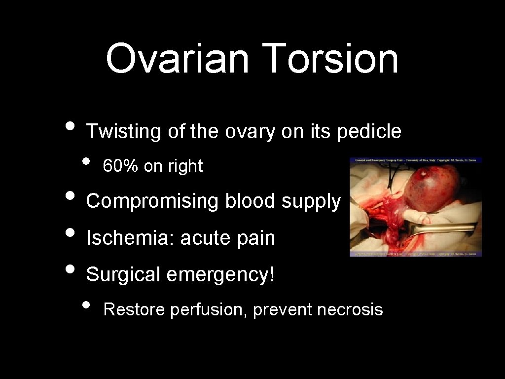 Ovarian Torsion • Twisting of the ovary on its pedicle • 60% on right
