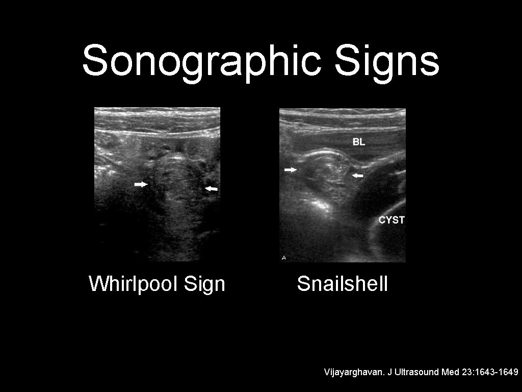 Sonographic Signs Whirlpool Sign Snailshell Vijayarghavan. J Ultrasound Med 23: 1643 -1649 