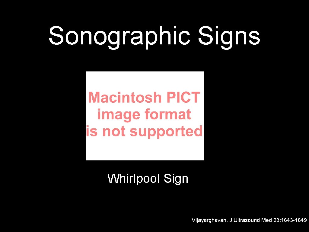 Sonographic Signs Whirlpool Sign Vijayarghavan. J Ultrasound Med 23: 1643 -1649 