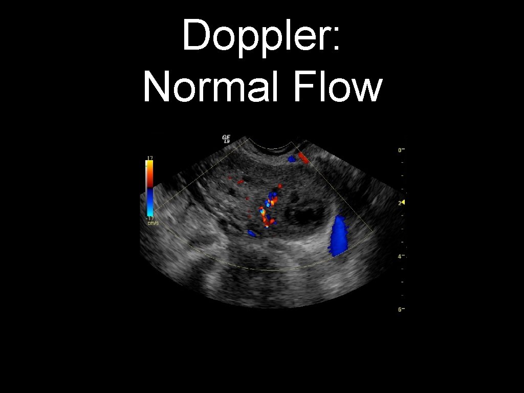 Doppler: Normal Flow 