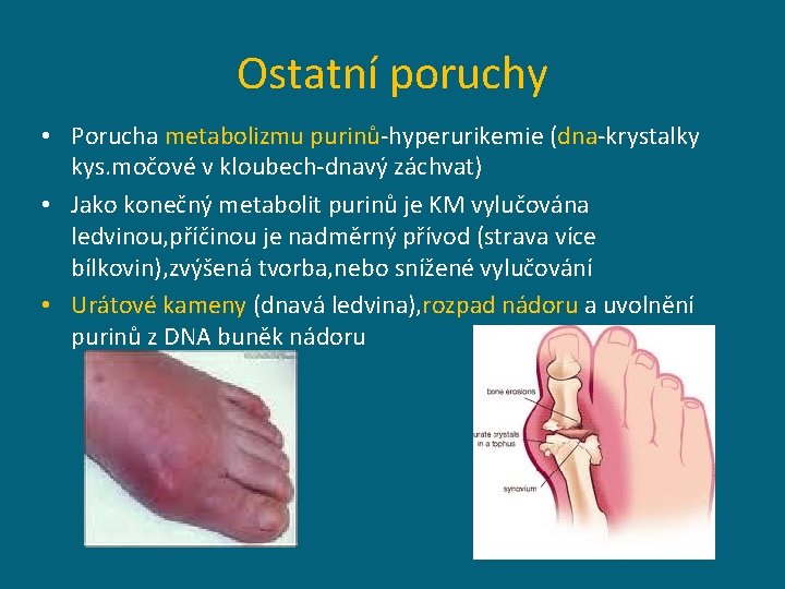 Ostatní poruchy • Porucha metabolizmu purinů-hyperurikemie (dna-krystalky kys. močové v kloubech-dnavý záchvat) • Jako