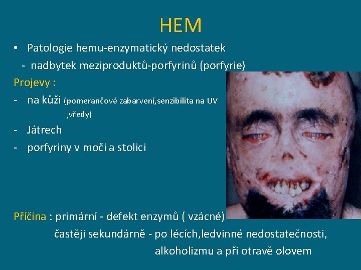 HEM • Patologie hemu-enzymatický nedostatek - nadbytek meziproduktů-porfyrinů (porfyrie) Projevy : - na kůži