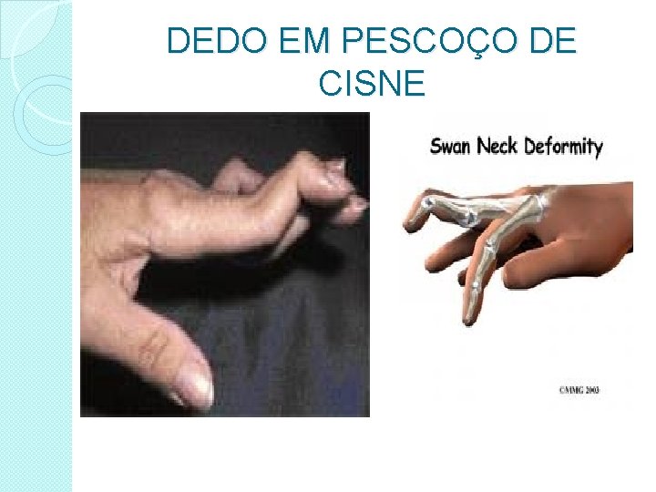 DEDO EM PESCOÇO DE CISNE 