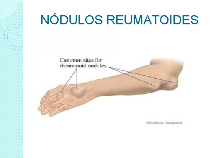 NÓDULOS REUMATOIDES 