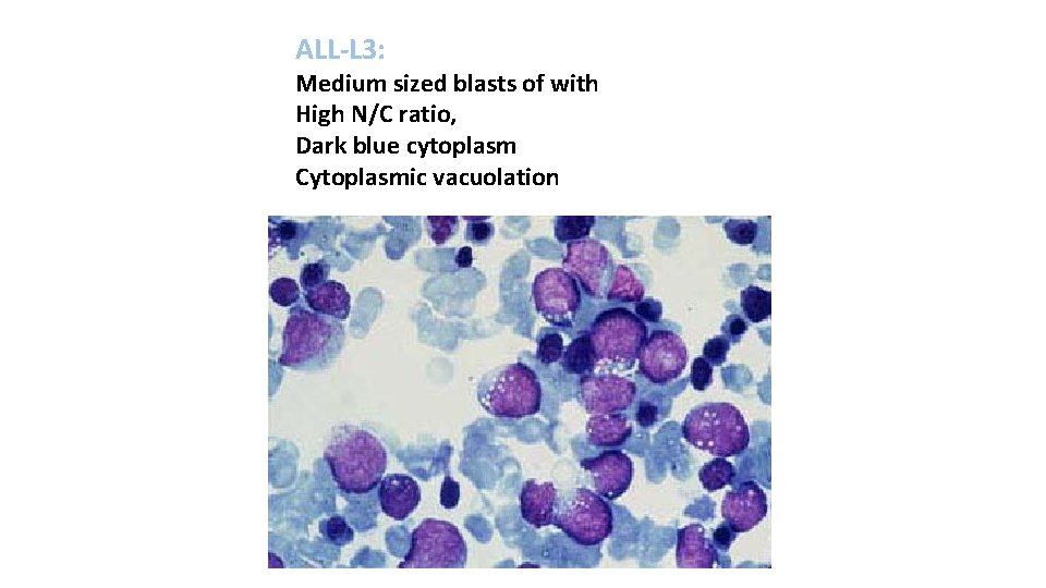 ALL-L 3: Medium sized blasts of with High N/C ratio, Dark blue cytoplasm Cytoplasmic