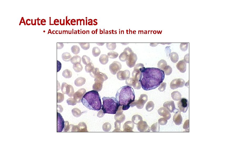 Acute Leukemias • Accumulation of blasts in the marrow 