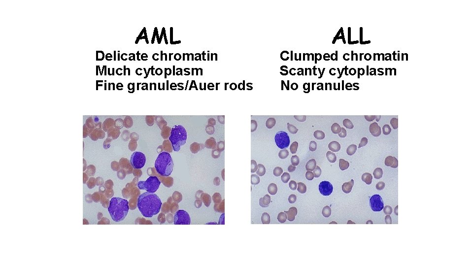 AML Delicate chromatin Much cytoplasm Fine granules/Auer rods ALL Clumped chromatin Scanty cytoplasm No