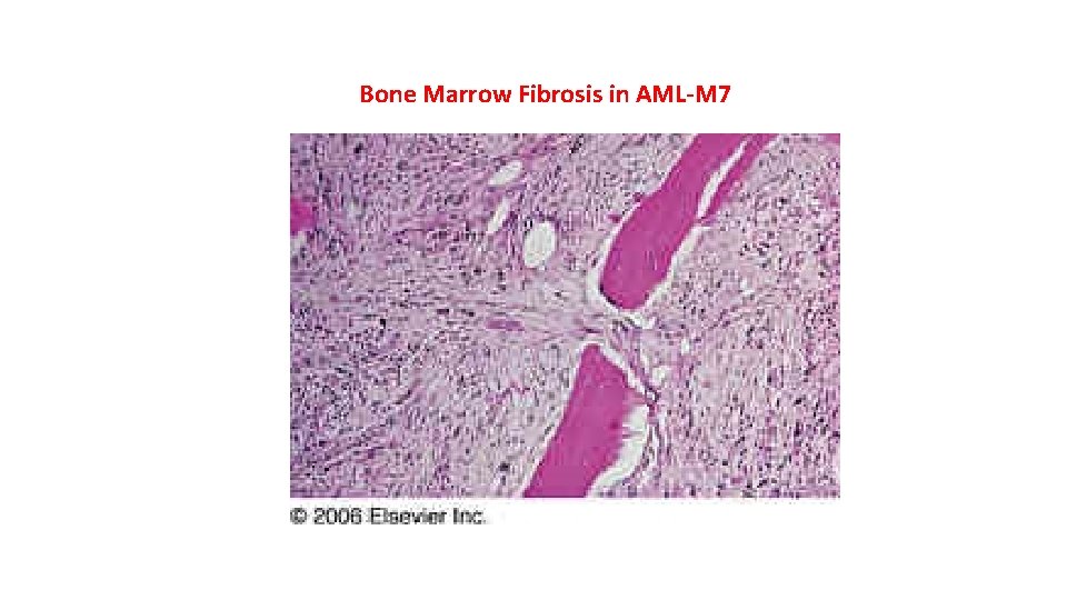 Bone Marrow Fibrosis in AML-M 7 