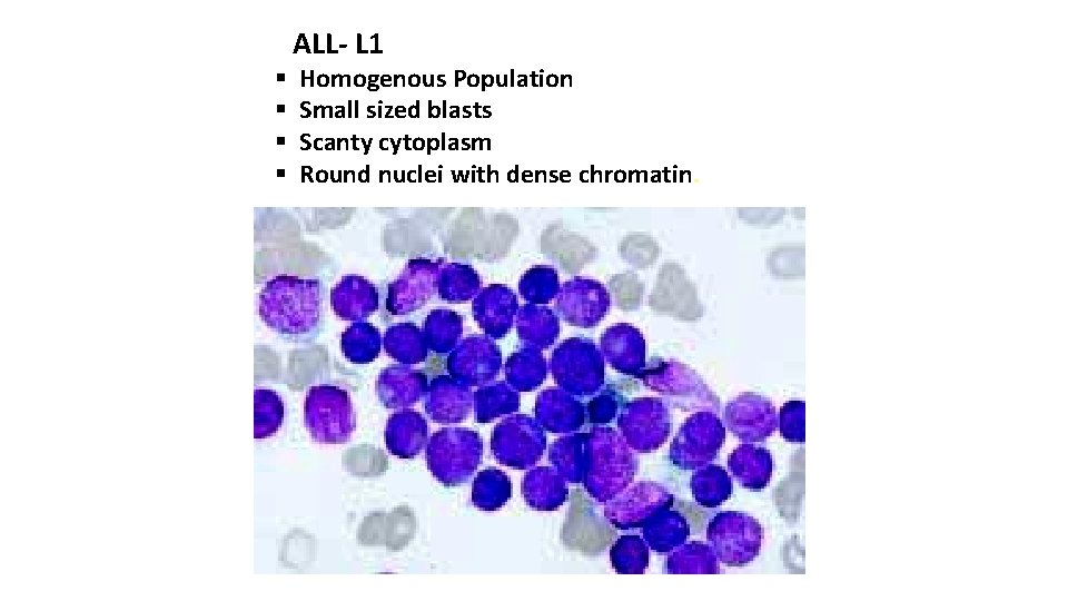 ALL- L 1 § § Homogenous Population Small sized blasts Scanty cytoplasm Round nuclei