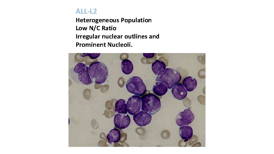 ALL-L 2 Heterogeneous Population Low N/C Ratio Irregular nuclear outlines and Prominent Nucleoli. 