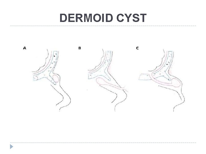 DERMOID CYST DERMOID CYST