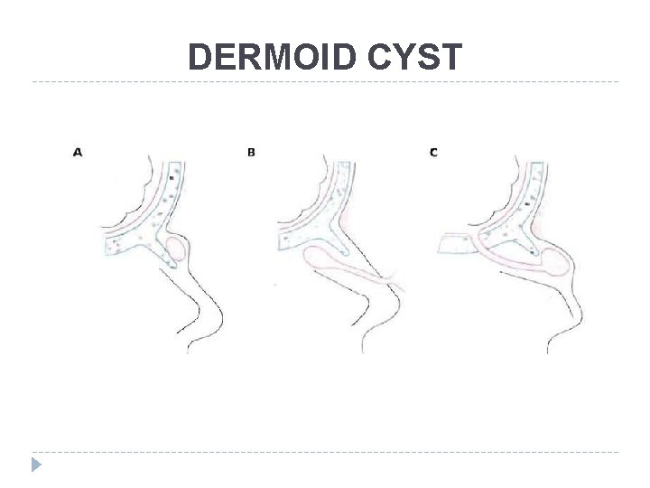 DERMOID CYST 