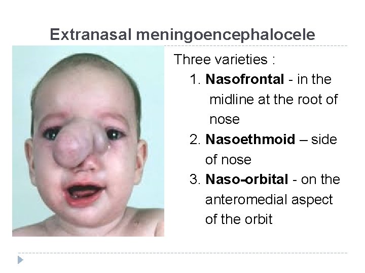 Extranasal meningoencephalocele Three varieties : 1. Nasofrontal - in the midline at the root Extranasal meningoencephalocele Three varieties : 1. Nasofrontal - in the midline at the root