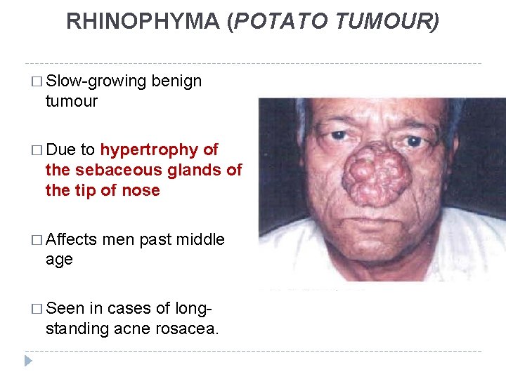 RHINOPHYMA (POTATO TUMOUR) � Slow-growing benign tumour � Due to hypertrophy of the sebaceous