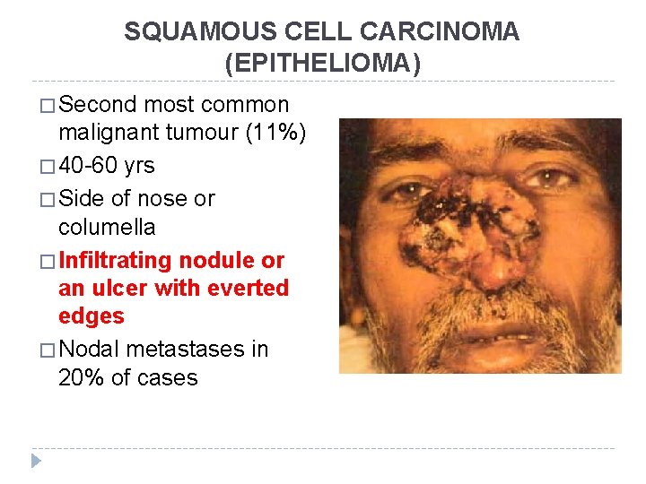 SQUAMOUS CELL CARCINOMA (EPITHELIOMA) � Second most common malignant tumour (11%) � 40 -60
