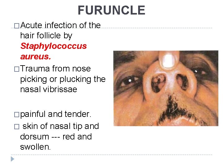 FURUNCLE �Acute infection of the hair follicle by Staphylococcus aureus. �Trauma from nose picking FURUNCLE �Acute infection of the hair follicle by Staphylococcus aureus. �Trauma from nose picking