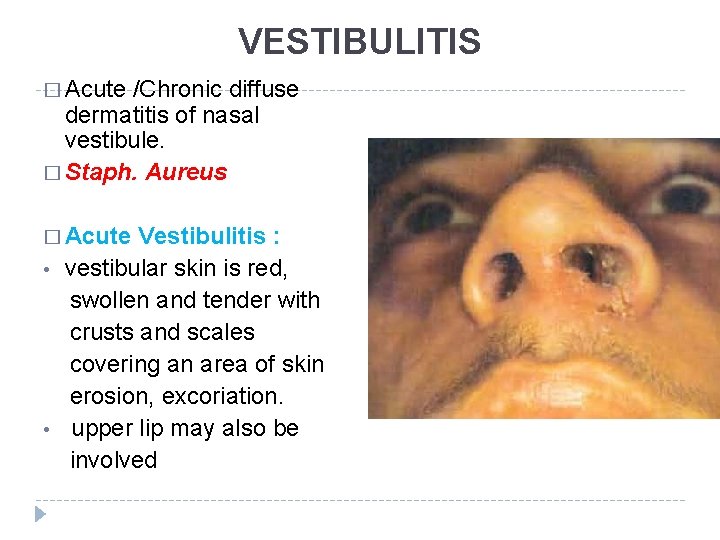 VESTIBULITIS � Acute /Chronic diffuse dermatitis of nasal vestibule. � Staph. Aureus � Acute VESTIBULITIS � Acute /Chronic diffuse dermatitis of nasal vestibule. � Staph. Aureus � Acute