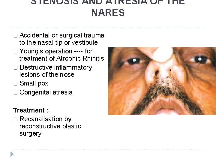 STENOSIS AND ATRESIA OF THE NARES � Accidental or surgical trauma to the nasal STENOSIS AND ATRESIA OF THE NARES � Accidental or surgical trauma to the nasal