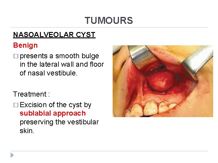 TUMOURS NASOALVEOLAR CYST Benign � presents a smooth bulge in the lateral wall and TUMOURS NASOALVEOLAR CYST Benign � presents a smooth bulge in the lateral wall and