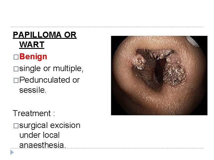 PAPILLOMA OR WART �Benign �single or multiple, �Pedunculated or sessile. Treatment : �surgical excision